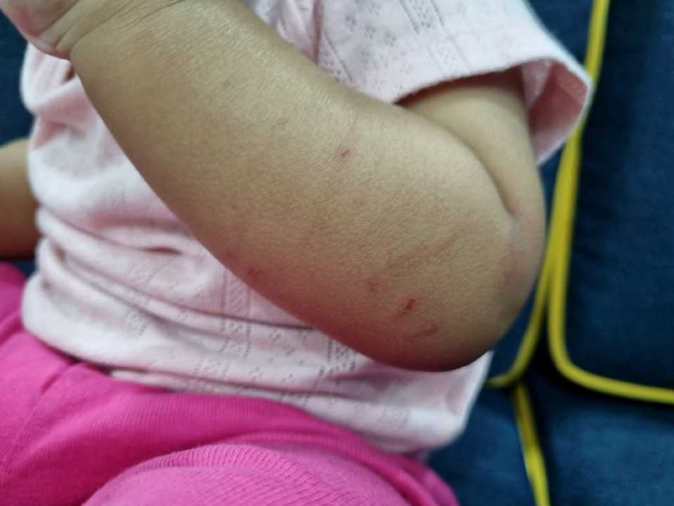 幼儿手臂多处咬痕  经核实属同龄儿童