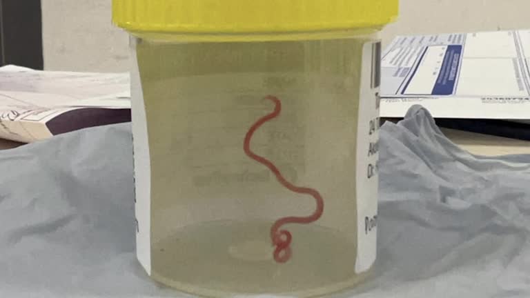 澳妇女大脑取出8厘米活虫  全球首例人类染蛇蛔虫