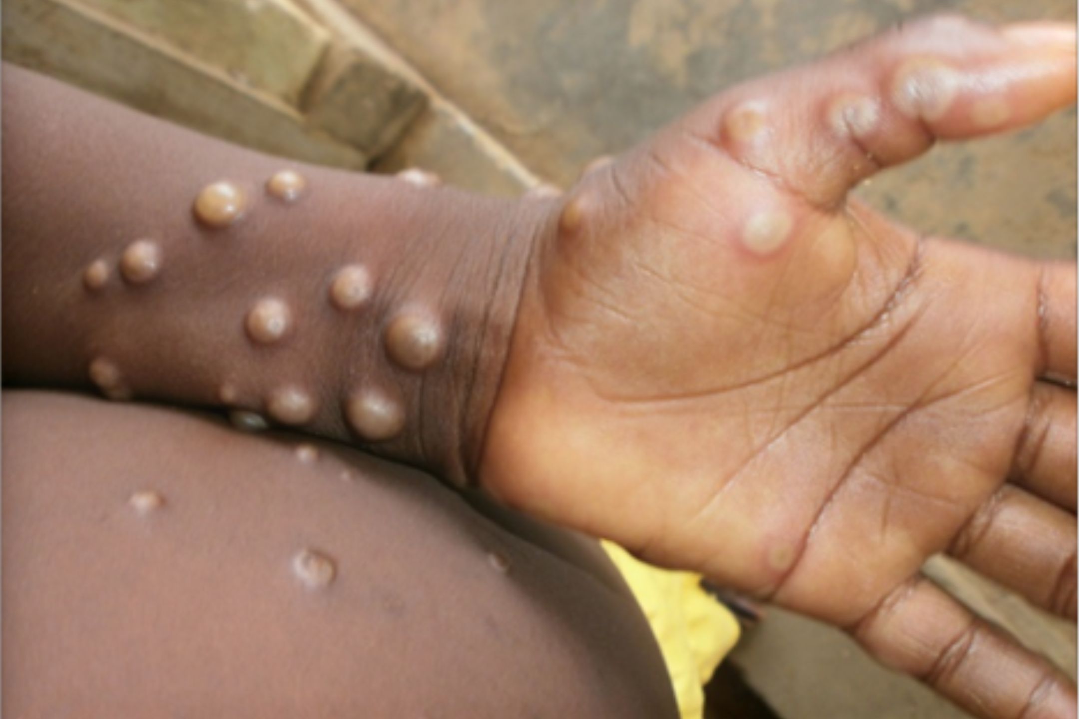柬埔寨添2猴痘病例 患者正隔离治疗